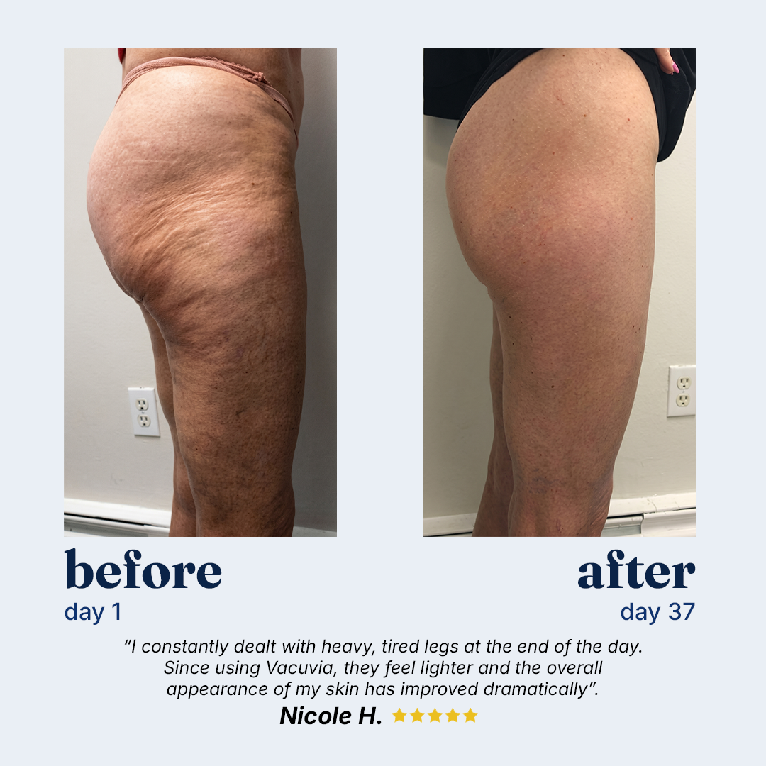Vacuvia® SculptGlow™ Firmer, More Toned Skin